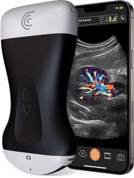 Portable Ultrasound Scanner